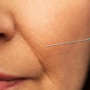 nasolabial folds
